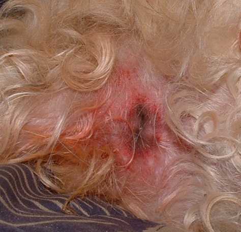 morsure de tique : granulome inflammatoire ou tumeur morsure de tique : granulome inflammatoire ou tumeur